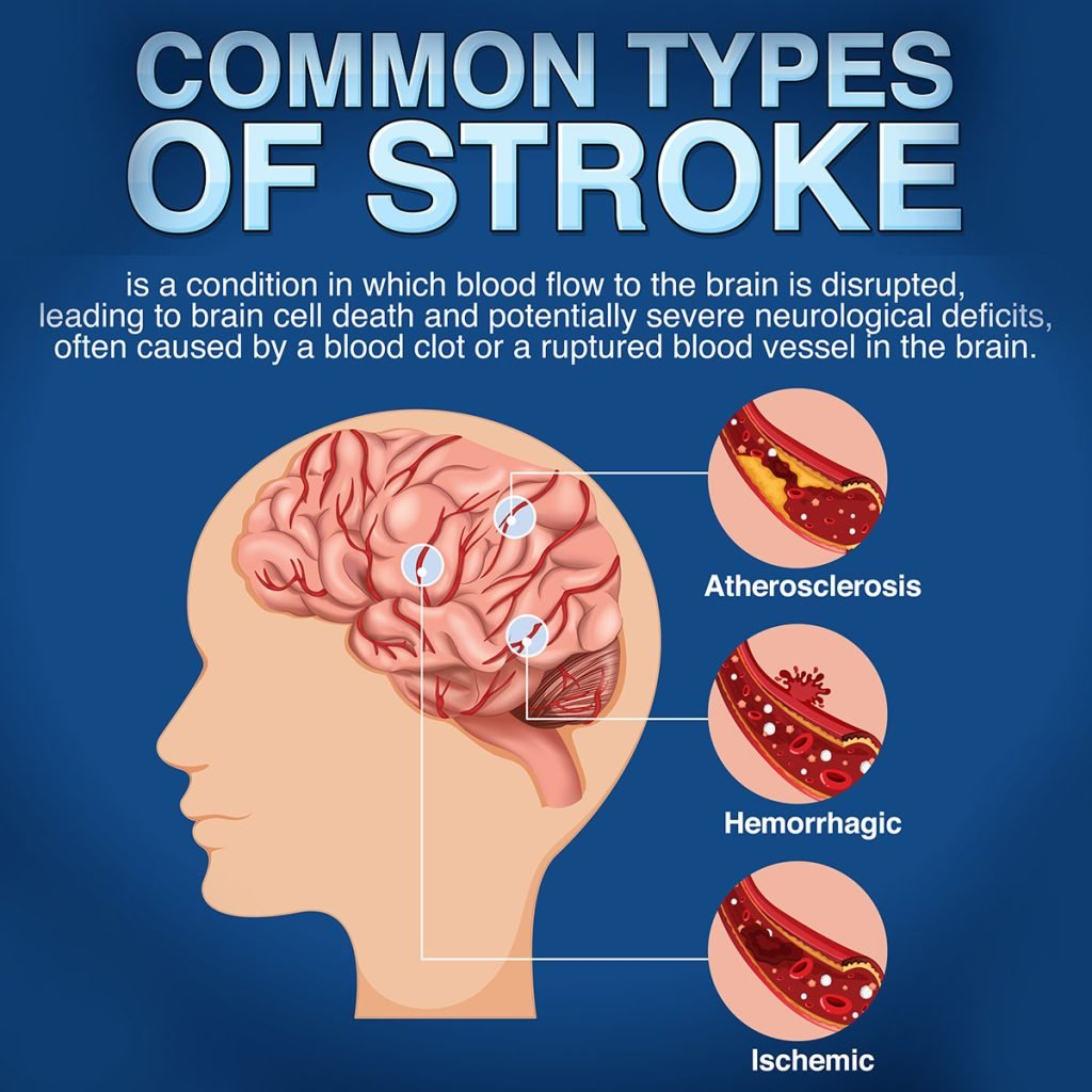 Types of Strokes