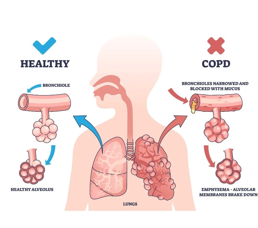 Stem Cell Treatment for Bronchitis/Asthma