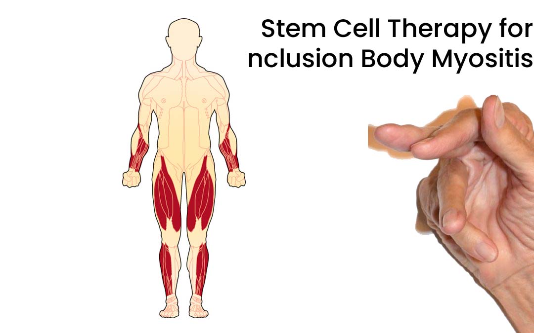 Stem Cell Therapy for Inclusion Body Myositis