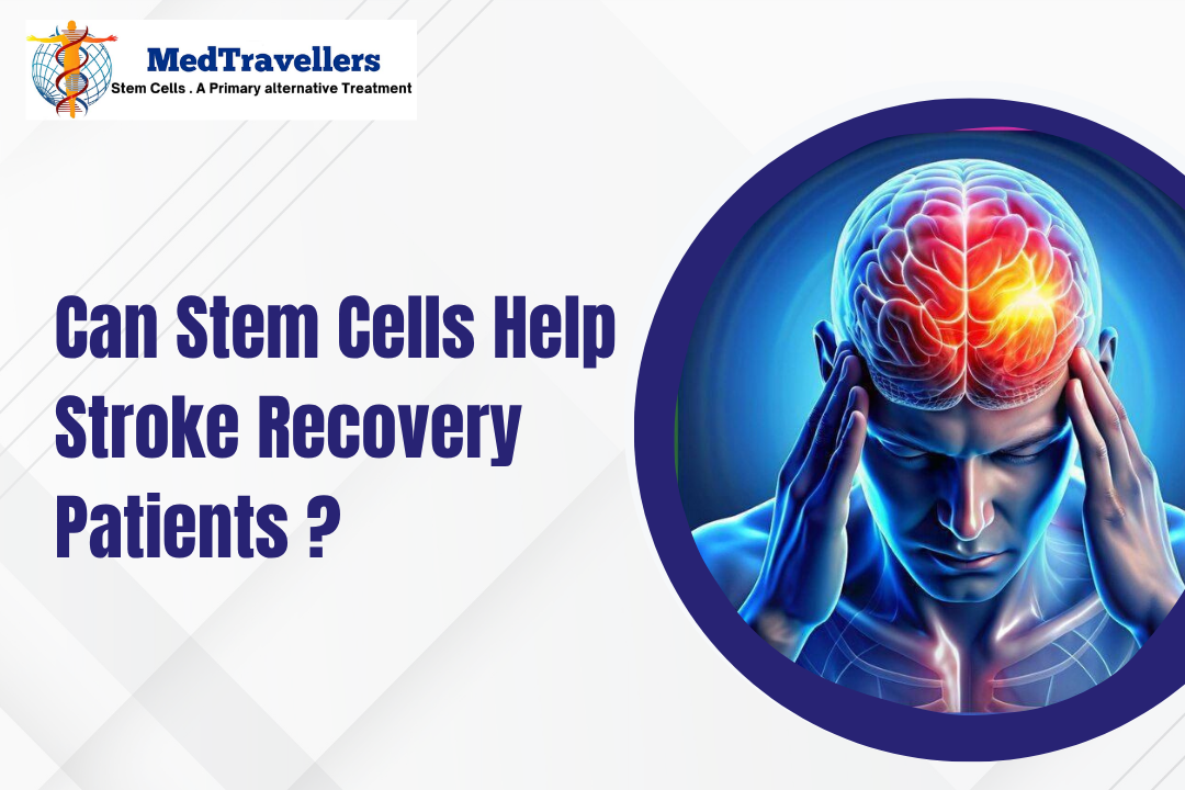 Can Stem Cells Help Stroke Recovery Patients